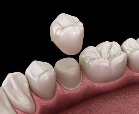 Who Can Benefit From CEREC Crowns?