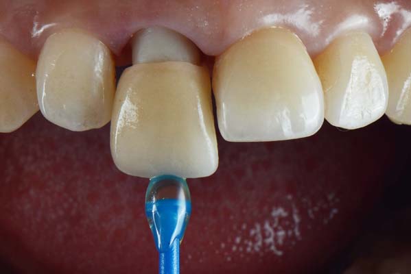 How Does A Dentist Prepare A Tooth For A Dental Crown?