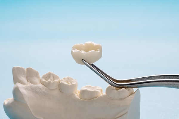 The Benefits Of Dental Crowns For Your Oral Health