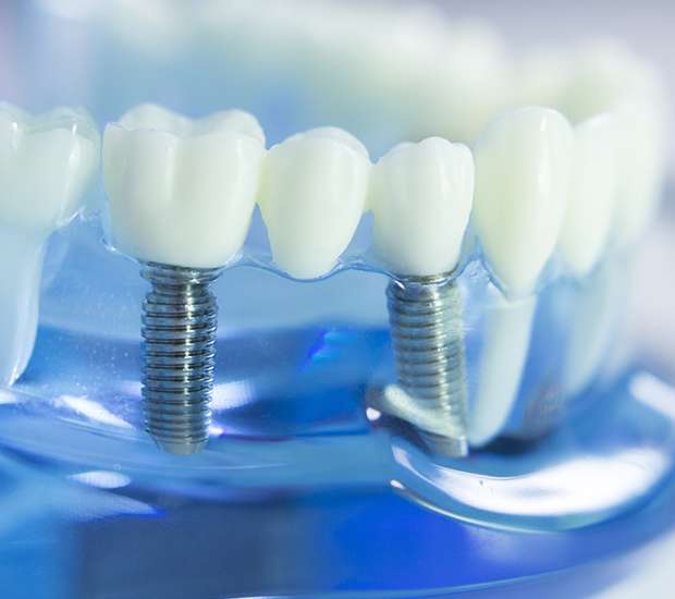 Southington Dental Implants