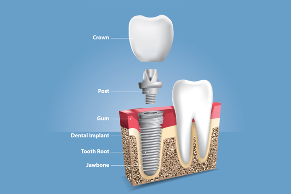 Understanding The Long Term Benefits Of Dental Implants